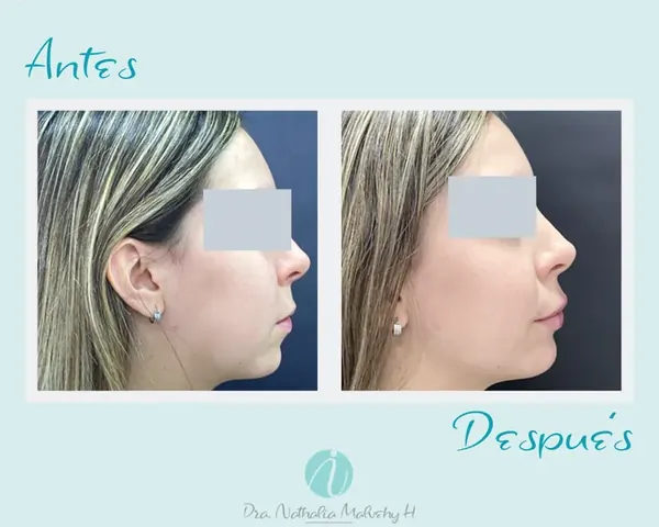 Antes y después de un paciente real: Ácido hialurónico