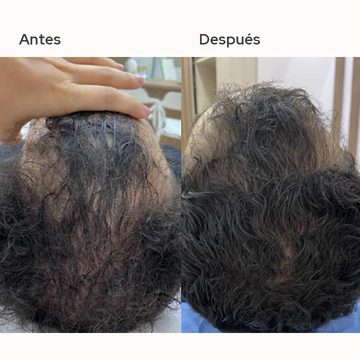Antes y después de un paciente real: Bioregulación hormonal capilar