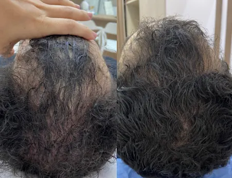 Antes y después de un paciente real: Tratamiento capilar
