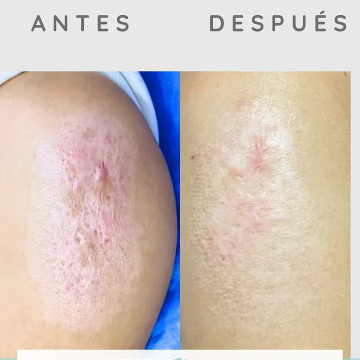 Antes y después de un paciente real: Láser CO2 para cicatrices