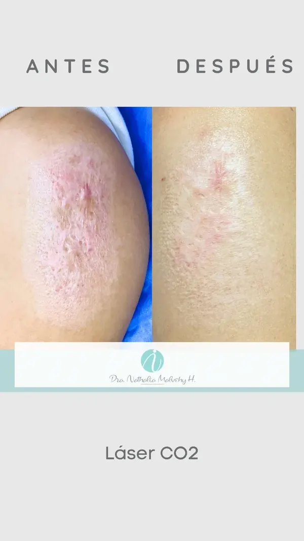 Antes y después de un paciente real: Láser CO2