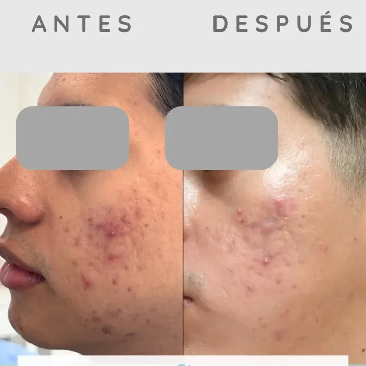 Antes y después de un paciente real: Mesoterapia Heel Balance