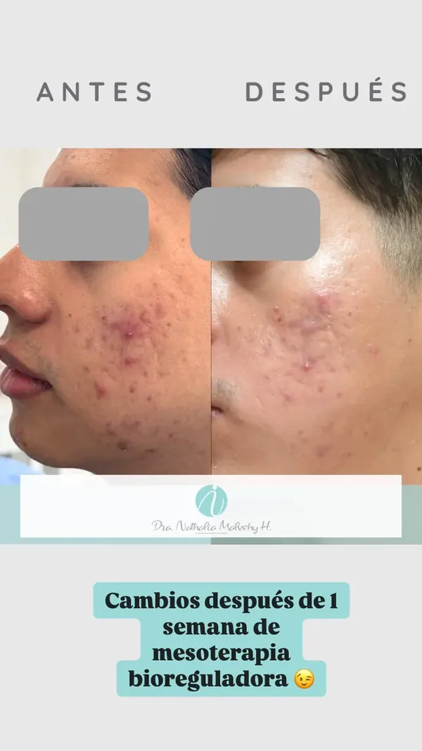 Antes y después de un paciente real: Mesoterapia bioreguladora