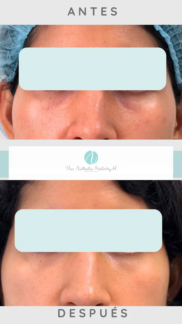 Antes y después de un paciente real: Ácido hialurónico en ojeras