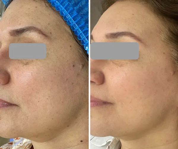 Antes y después de un paciente real: Láser CO2 peeling facial