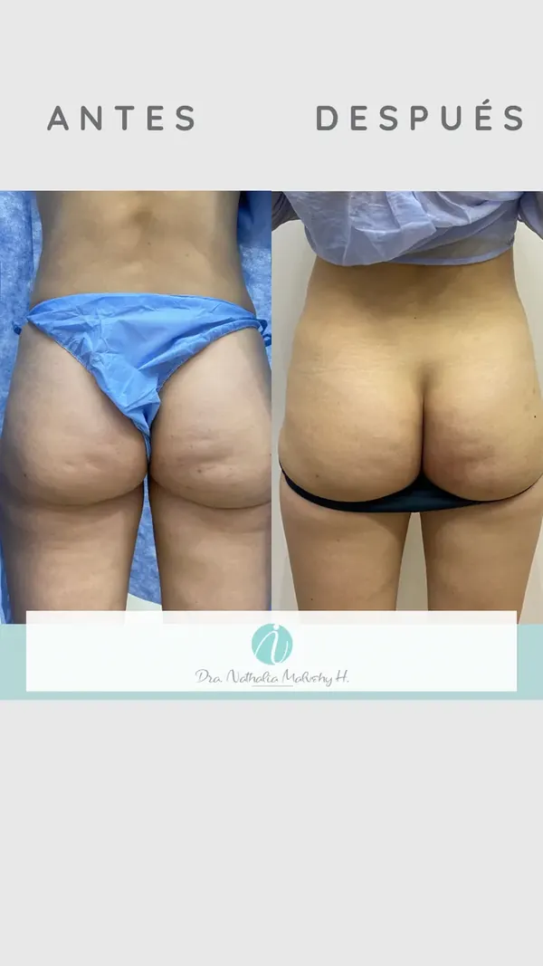 Antes y después de un paciente real: Bioestimulación con Radiesse