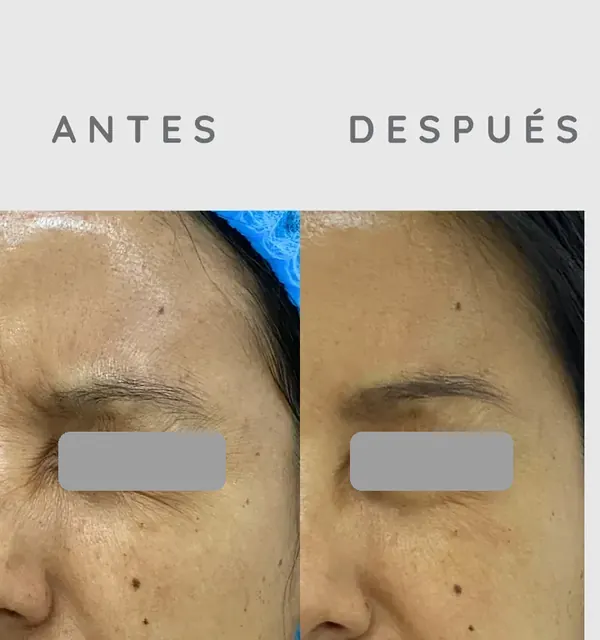 Antes y después de un paciente real: Toxina botulínica